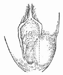 前庭大腺又称巴氏腺(bartholin"sglands),是位于阴道口两侧在前庭球