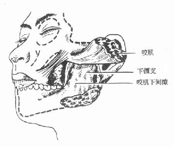 第五节 口腔颌面部炎症(infections of oral andmaxillo-facial