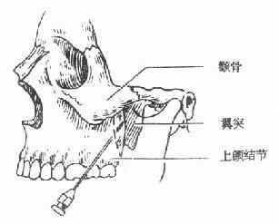 鼻腭神经阻滞麻醉(节牙孔注射:见图5～4图5～3 腭大孔注射图5～4 节