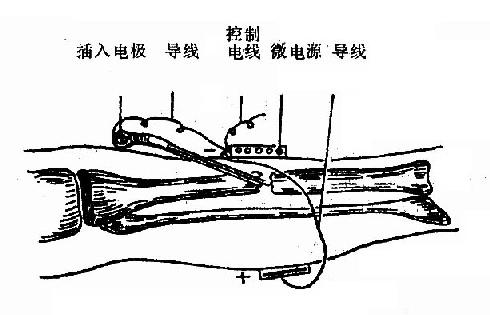 微弱直流电刺激骨折生长示意图