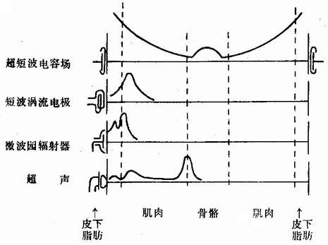 四种深部透热治疗时各层组织温热曲线