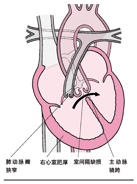 中医书籍《默克家庭诊疗手册 左室发育不良综合征又称左心发育不良
