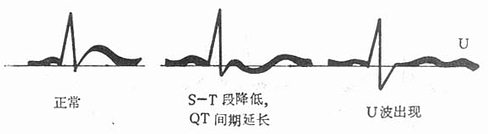 低钾血症的心电图变化