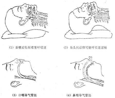 全身麻醉时上呼吸道梗阻及保持上呼吸道通畅的方法