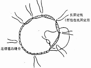 大片植皮缝合法