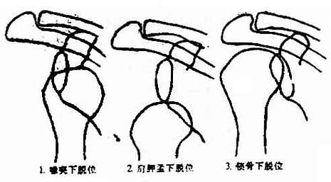 肩关节盂下脱位图片