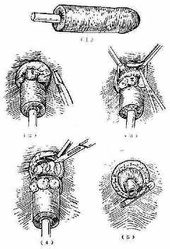混合痔疮环切手术图解图片